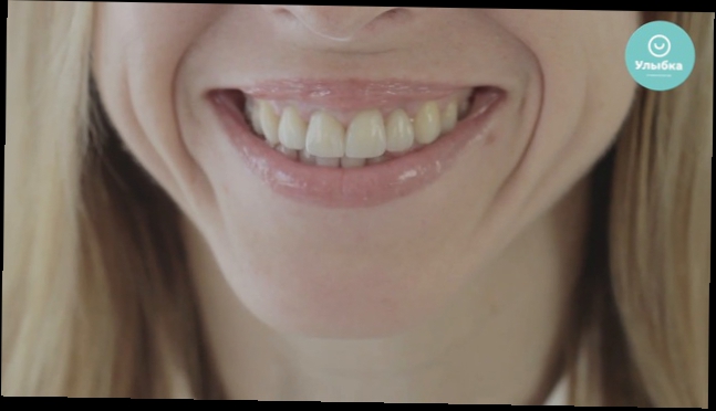Видеоклип Эстетическая реставрация зубов. Стоматология 
